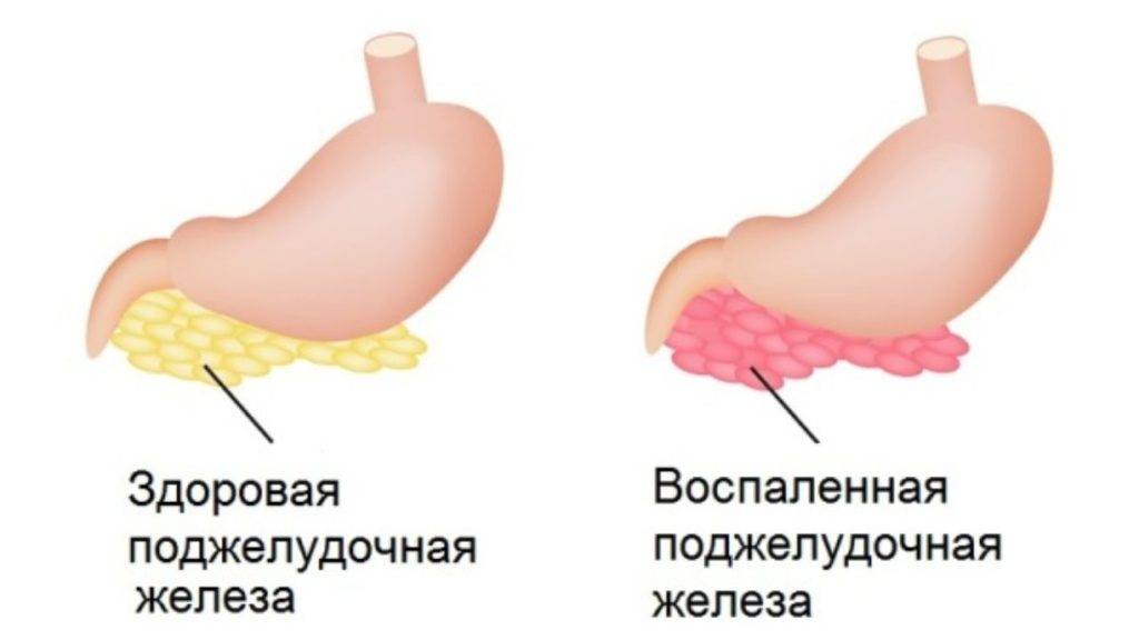 Воспаление поджелудочной. Здоровая поджелудочная железа. Здоровая и воспаленная поджелудочная железа. Панкреатит у бройлеров. Панкреатит у собак ожирения.