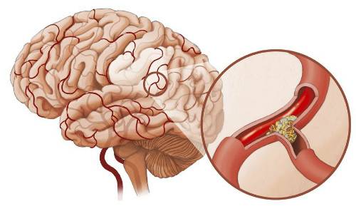 Диета при атеросклерозе сосудов головного мозга — сердце