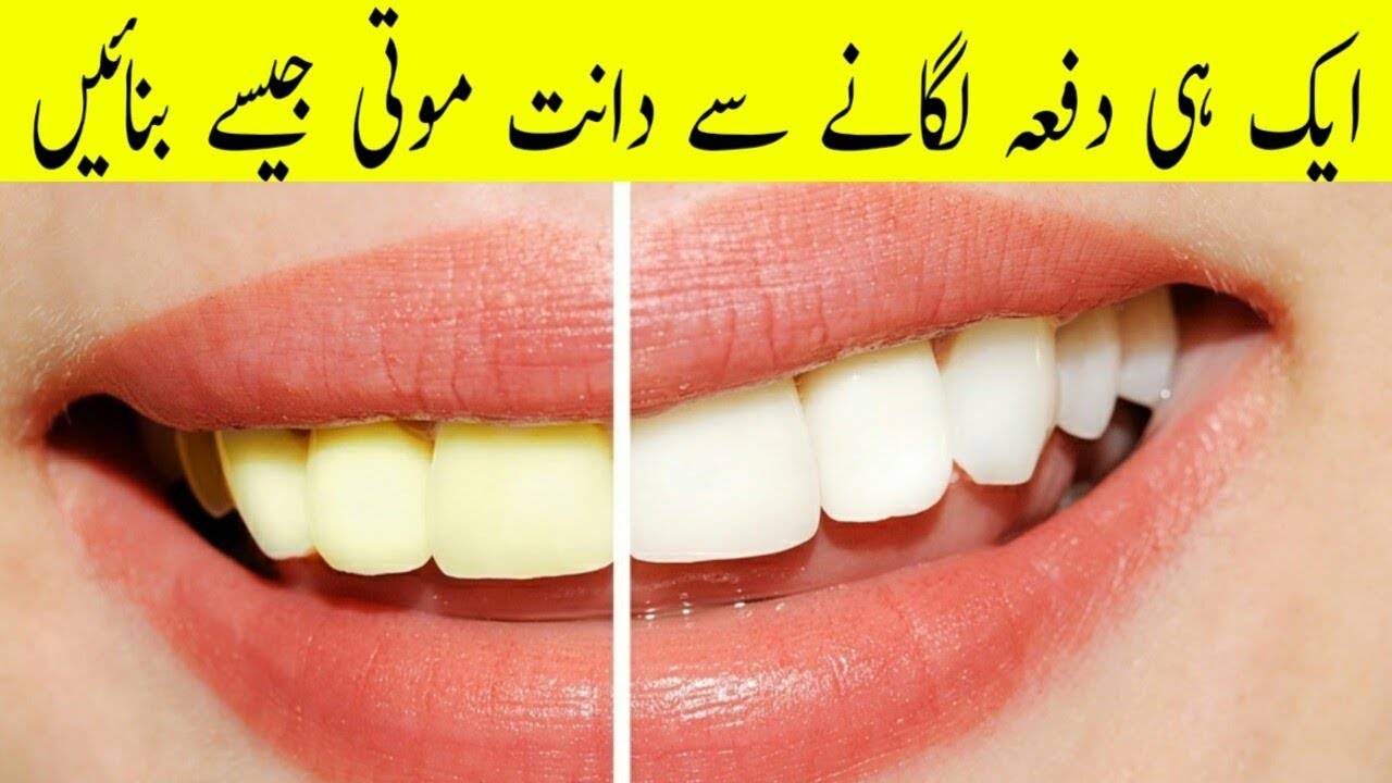 Желтые зубы - лечение и причины