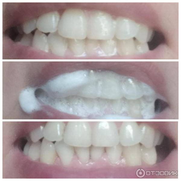 Черный налет на зубах: как удалить – стоматология президент